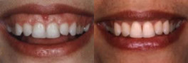 Gummy smile prima e dopo l'allungamento  mircrochirurgico dei denti tramite laser 