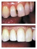 Otturazioni infiltrate di denti frontali cariati, prima e dopo il trattamento con otturazioni in composito 