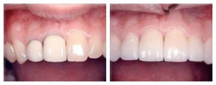 Prima e dopo il trattamento dei denti incisivi con corone in ceramica integrale  